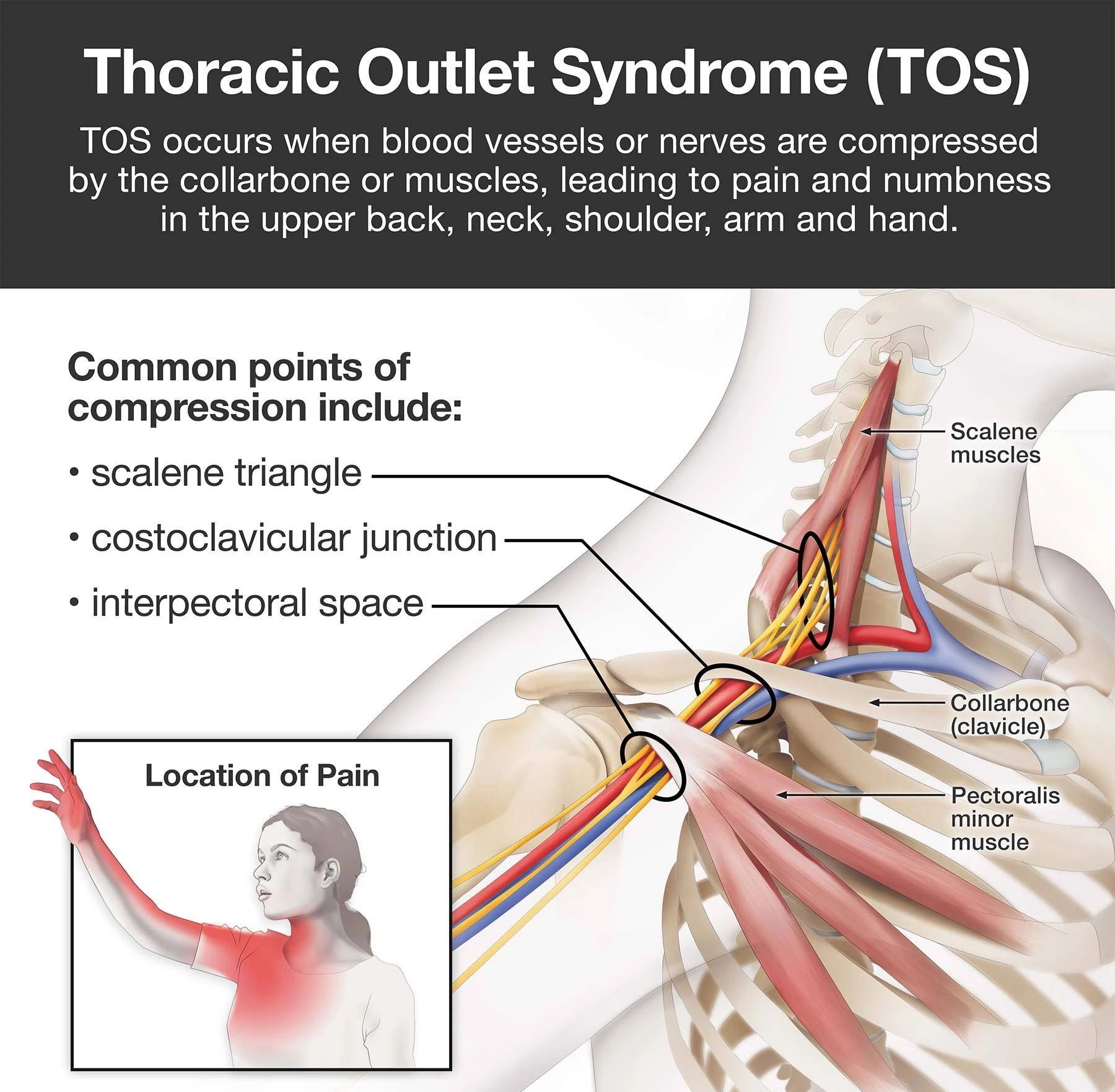 More insights into Thoracic Outlet syndrome